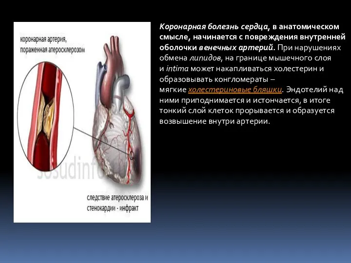 Коронарная болезнь сердца, в анатомическом смысле, начинается с повреждения внутренней оболочки венечных