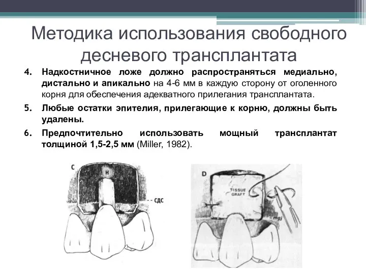 Методика использования свободного десневого трансплантата Надкостничное ложе должно распространяться медиально, дистально и