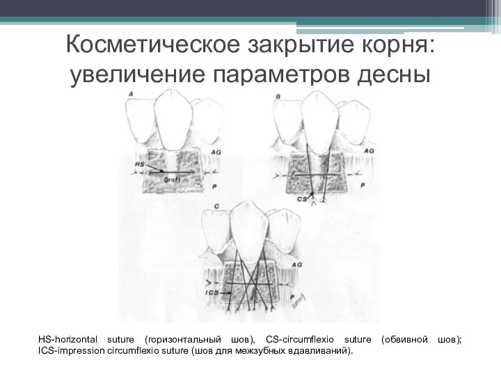 Косметическое закрытие корня: увеличение параметров десны HS-horizontal suture (горизонтальный шов), CS-circumflexio suture