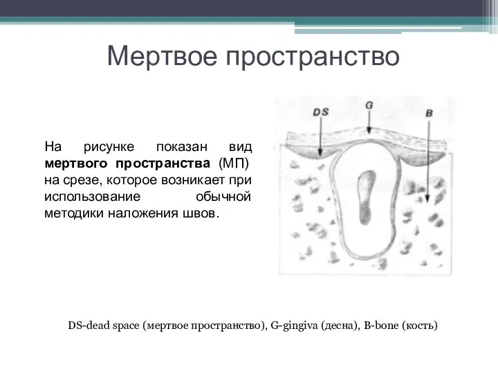 Мертвое пространство На рисунке показан вид мертвого пространства (МП) на срезе, которое