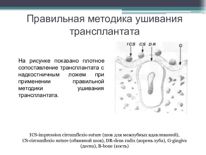 Правильная методика ушивания трансплантата На рисунке показано плотное сопоставление трансплантата с надкостничным