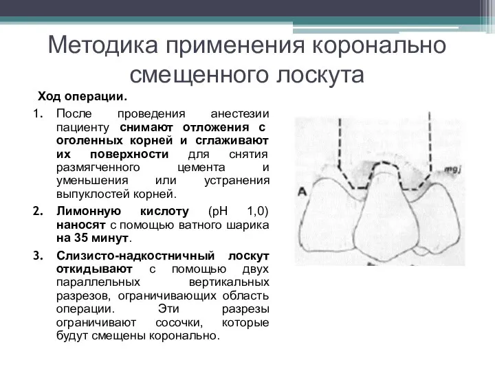 Методика применения коронально смещенного лоскута Ход операции. После проведения анестезии пациенту снимают