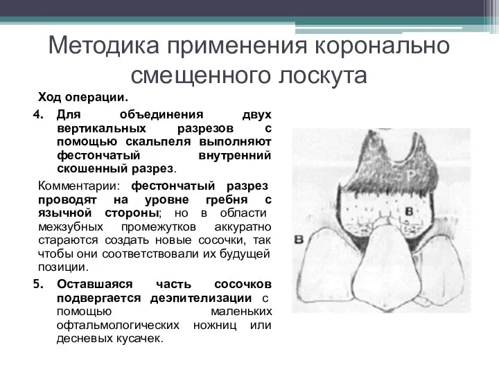 Методика применения коронально смещенного лоскута Ход операции. Для объединения двух вертикальных разрезов