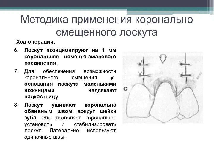 Методика применения коронально смещенного лоскута Ход операции. Лоскут позиционируют на 1 мм