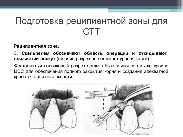 Подготовка реципиентной зоны для СТТ Реципиентная зона. 3. Скальпелем обозначают область операции