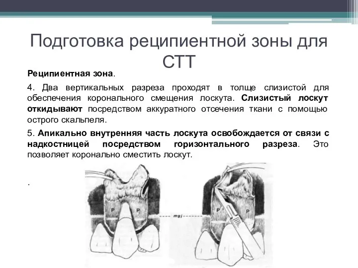 Подготовка реципиентной зоны для СТТ Реципиентная зона. 4. Два вертикальных разреза проходят