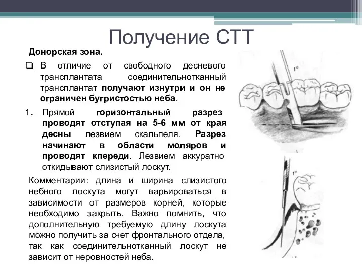 Получение СТТ Донорская зона. В отличие от свободного десневого трансплантата соединительнотканный трансплантат