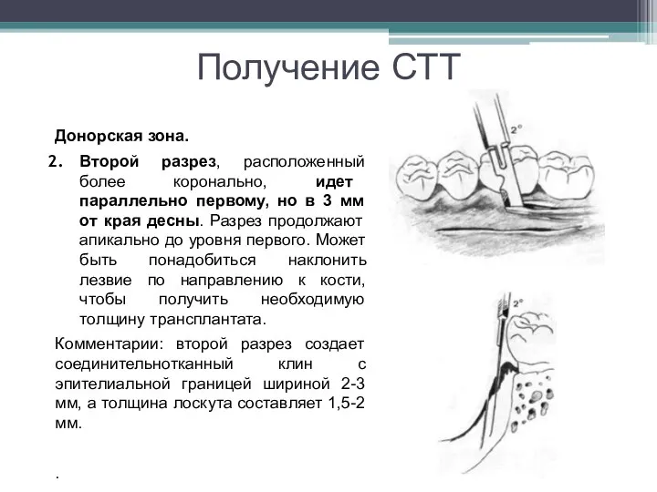 Получение СТТ Донорская зона. Второй разрез, расположенный более коронально, идет параллельно первому,