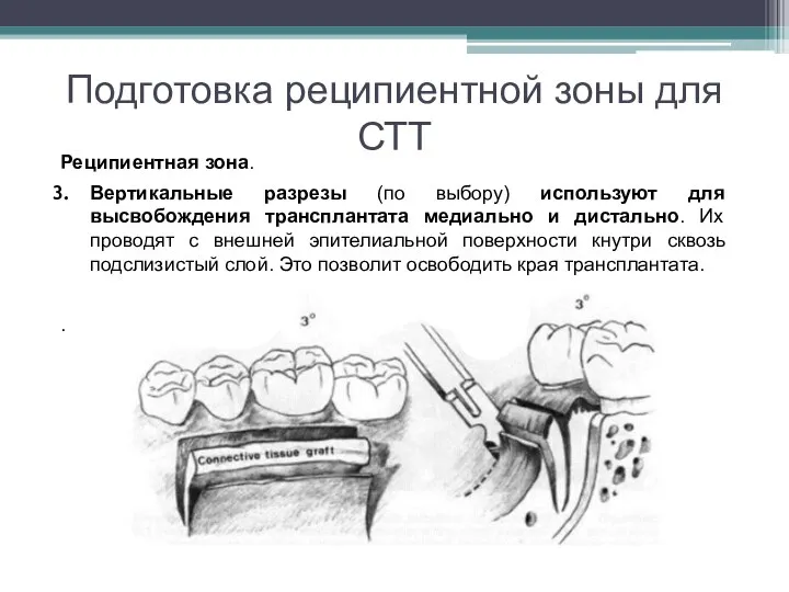 Подготовка реципиентной зоны для СТТ Реципиентная зона. Вертикальные разрезы (по выбору) используют