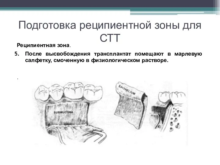 Подготовка реципиентной зоны для СТТ Реципиентная зона. После высвобождения трансплантат помещают в