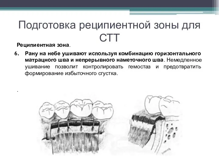 Подготовка реципиентной зоны для СТТ Реципиентная зона. Рану на небе ушивают используя