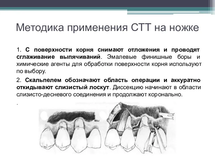 Методика применения СТТ на ножке 1. С поверхности корня снимают отложения и