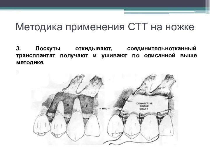 Методика применения СТТ на ножке 3. Лоскуты откидывают, соединительнотканный трансплантат получают и