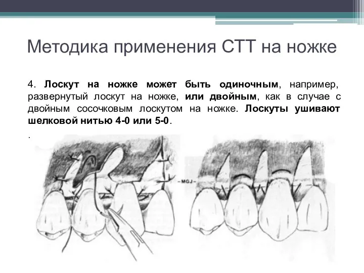 Методика применения СТТ на ножке 4. Лоскут на ножке может быть одиночным,