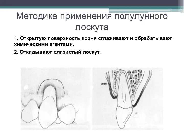 Методика применения полулунного лоскута 1. Открытую поверхность корня сглаживают и обрабатывают химическими