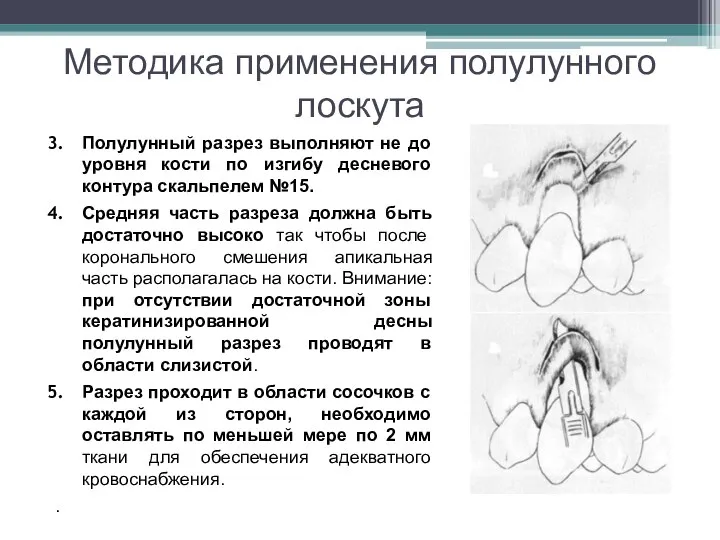 Методика применения полулунного лоскута Полулунный разрез выполняют не до уровня кости по