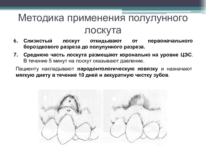 Методика применения полулунного лоскута Слизистый лоскут откидывают от первоначального бороздкового разреза до