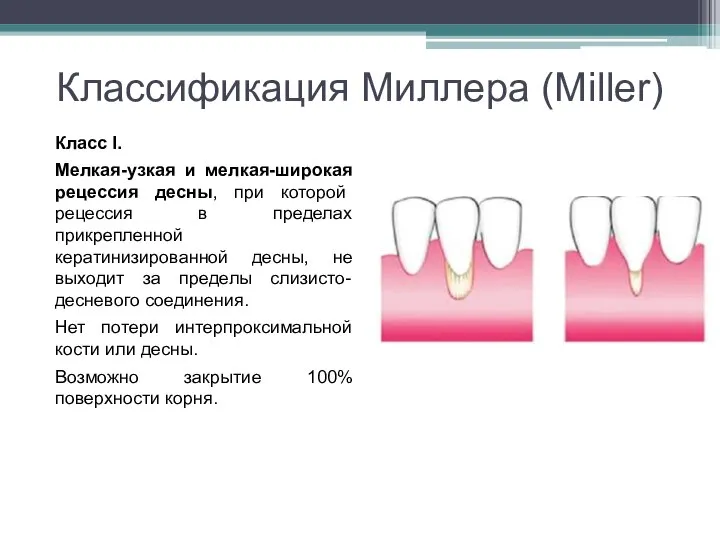 Классификация Миллера (Miller) Класс I. Мелкая-узкая и мелкая-широкая рецессия десны, при которой