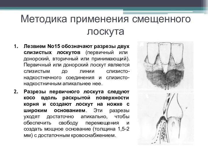 Методика применения смещенного лоскута Лезвием No15 обозначают разрезы двух слизистых лоскутов (первичный