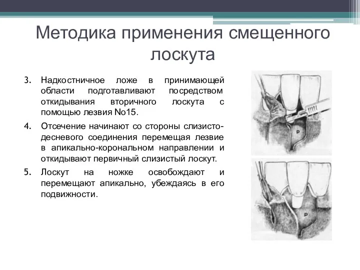 Методика применения смещенного лоскута Надкостничное ложе в принимающей области подготавливают посредством откидывания