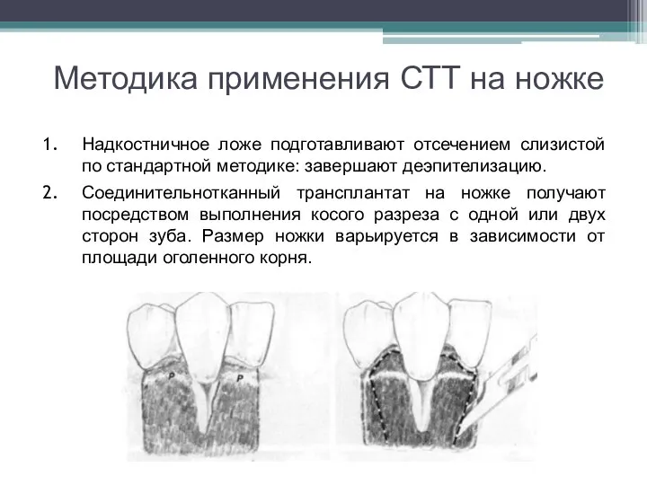 Методика применения СТТ на ножке Надкостничное ложе подготавливают отсечением слизистой по стандартной