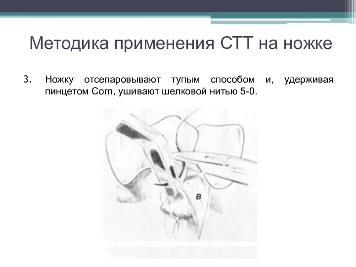 Методика применения СТТ на ножке Ножку отсепаровывают тупым способом и, удерживая пинцетом