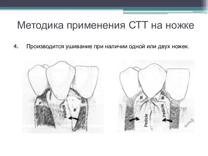 Методика применения СТТ на ножке Производится ушивание при наличии одной или двух ножек.