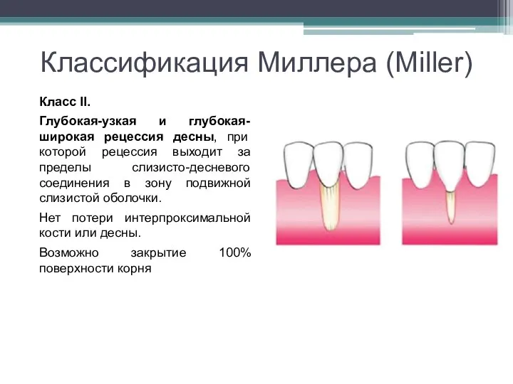 Классификация Миллера (Miller) Класс II. Глубокая-узкая и глубокая-широкая рецессия десны, при которой