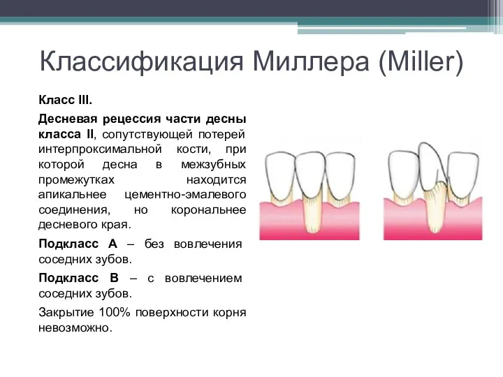 Классификация Миллера (Miller) Класс III. Десневая рецессия части десны класса II, сопутствующей