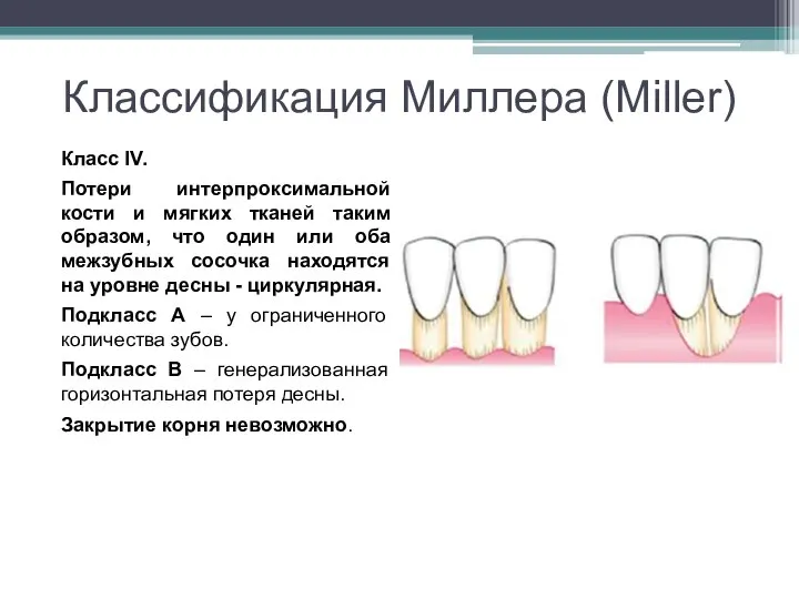 Классификация Миллера (Miller) Класс IV. Потери интерпроксимальной кости и мягких тканей таким