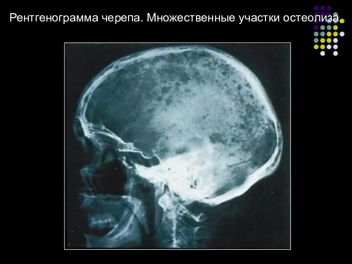 Рентгенограмма черепа. Множественные участки остеолиза.