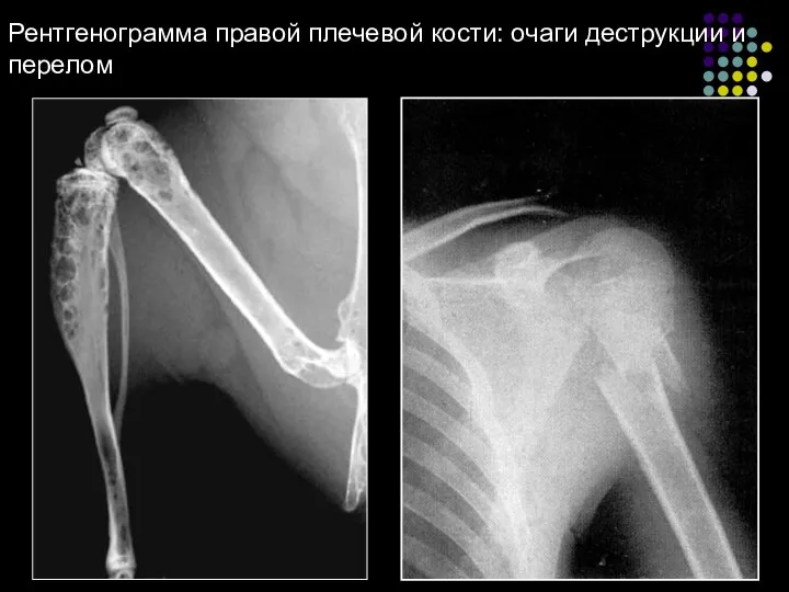 Рентгенограмма правой плечевой кости: очаги деструкции и перелом