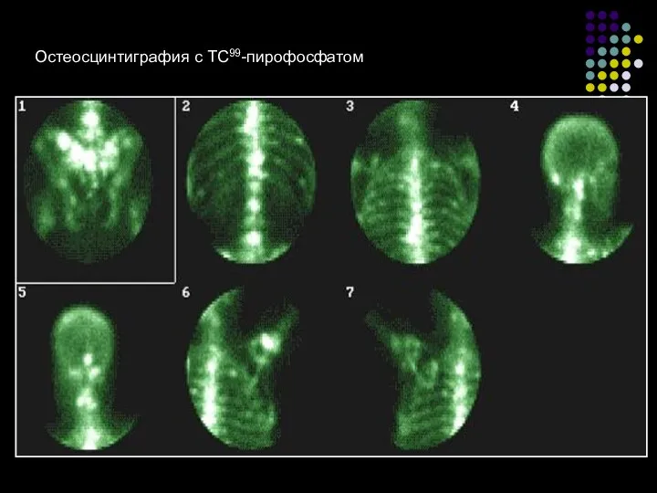 Остеосцинтиграфия с ТС99-пирофосфатом