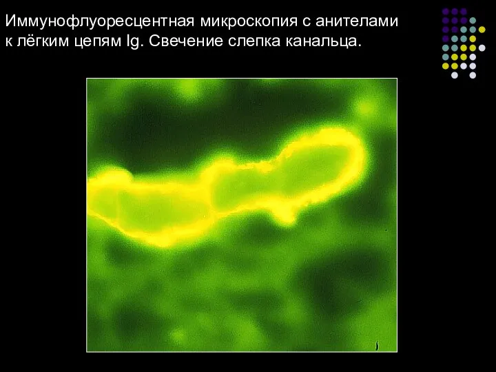 Иммунофлуоресцентная микроскопия с анителами к лёгким цепям Ig. Свечение слепка канальца.