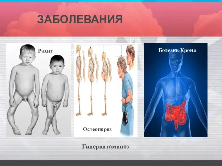 ЗАБОЛЕВАНИЯ Гипервитаминоз Рахит Остеопороз Болезнь Крона