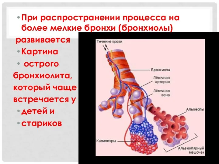 При распространении процесса на более мелкие бронхи (бронхиолы) развивается Картина острого бронхиолита,