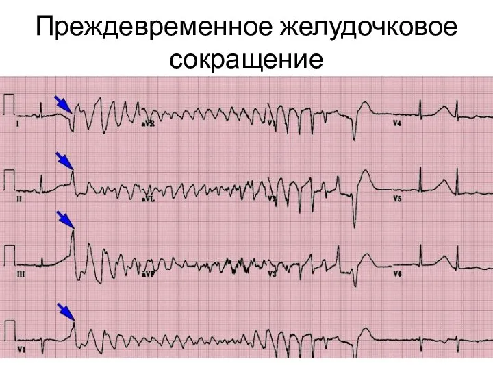 Преждевременное желудочковое сокращение