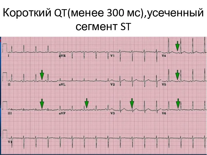 Короткий QT(менее 300 мс),усеченный сегмент ST