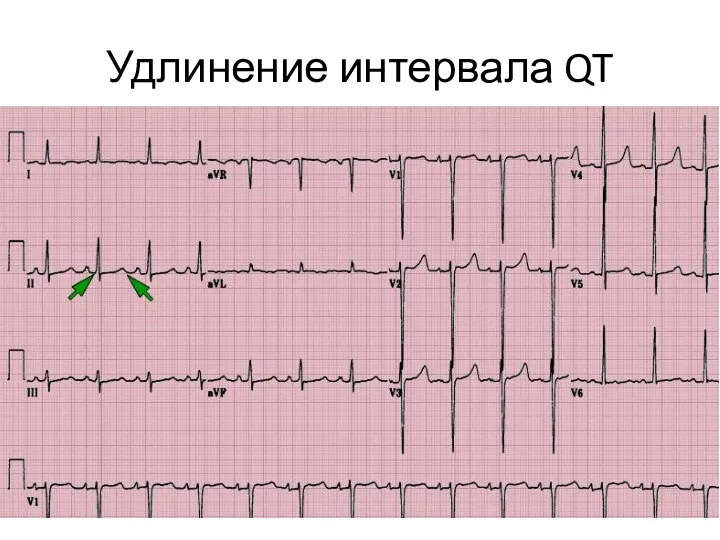 Удлинение интервала QT