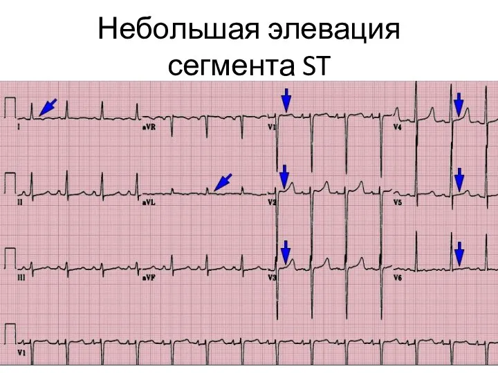 Небольшая элевация сегмента ST