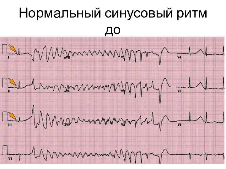 Нормальный синусовый ритм до