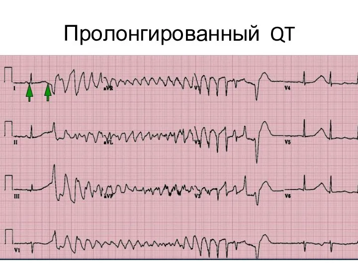 Пролонгированный QT