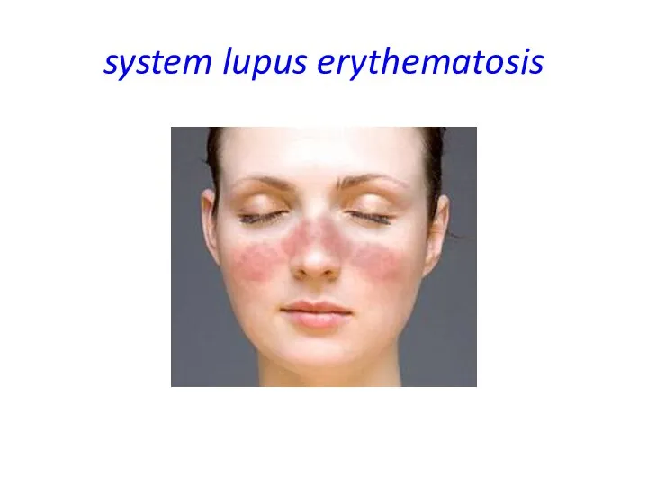 system lupus erythematosis