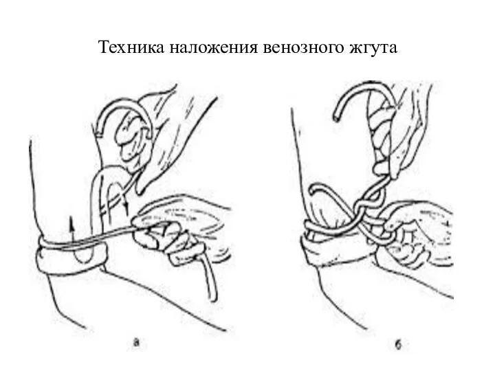 Техника наложения венозного жгута