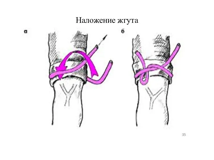 Наложение жгута