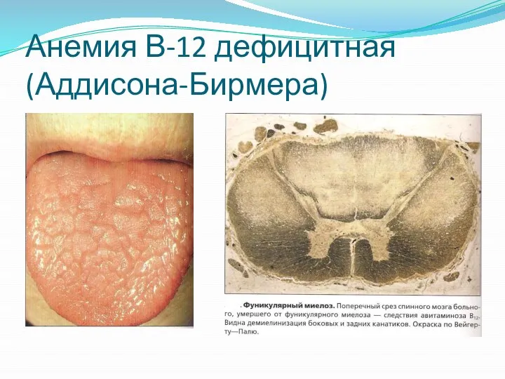 Анемия В-12 дефицитная (Аддисона-Бирмера)