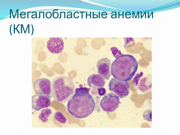 Мегалобластные анемии (КМ)