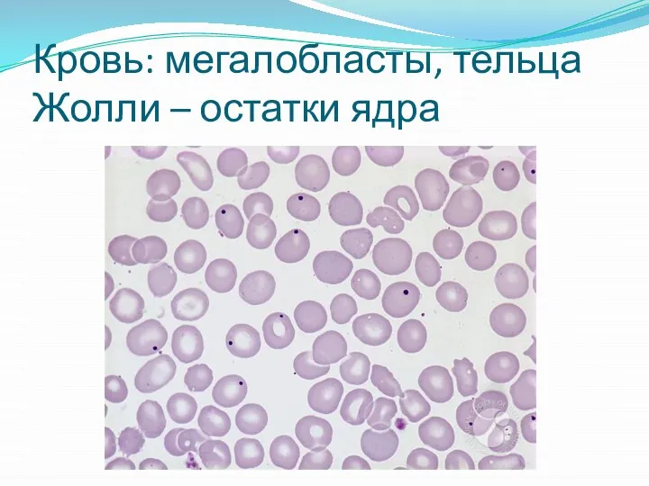 Кровь: мегалобласты, тельца Жолли – остатки ядра