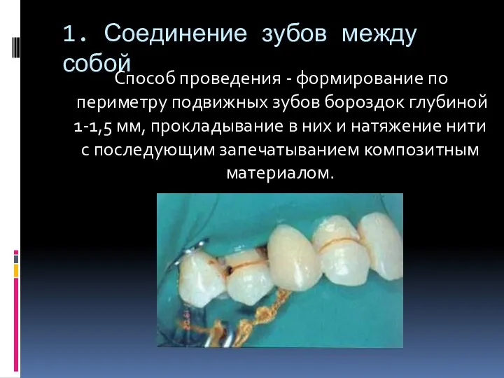 1. Соединение зубов между собой Способ проведения - формирование по периметру подвижных