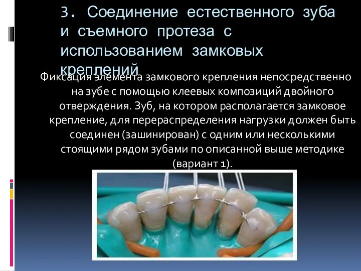 3. Соединение естественного зуба и съемного протеза с использованием замковых креплений Фиксация